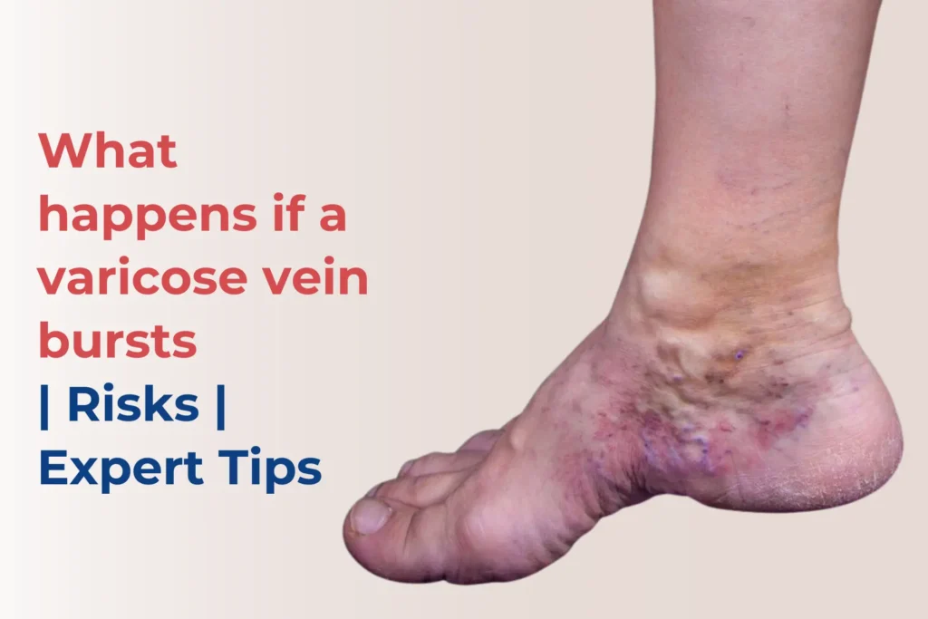 what happen when varicose vein bursts