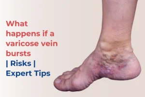 what happen when varicose vein bursts