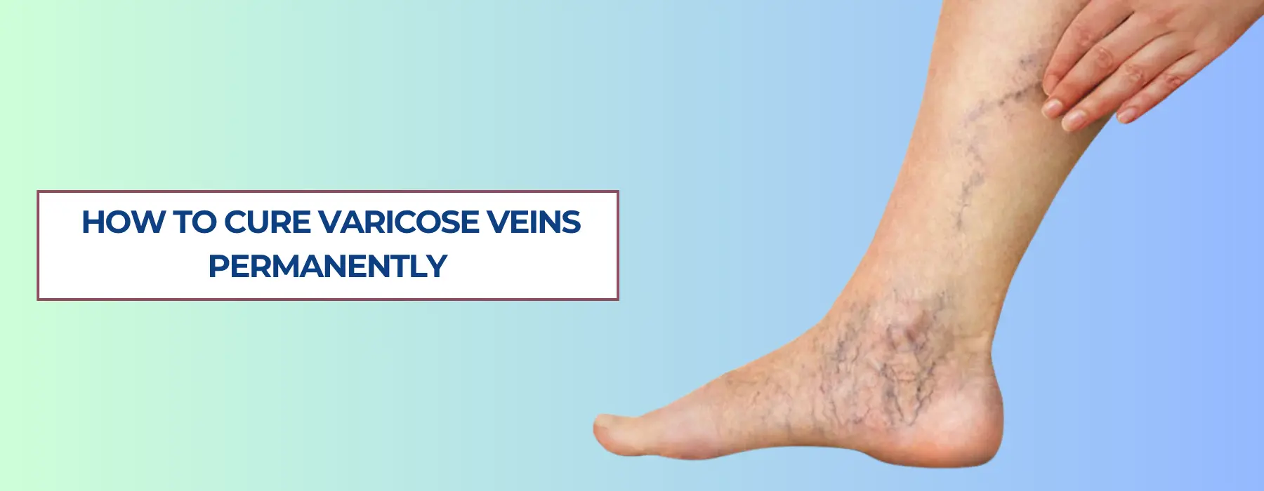 How To Cure Varicose Veins Permanently