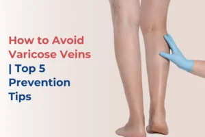 How to Avoid Varicose Veins tips