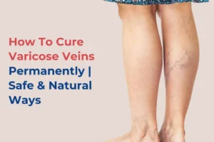 Varicose Veins cure