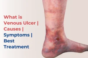 What is Venous Ulcer causes symptoms treatment