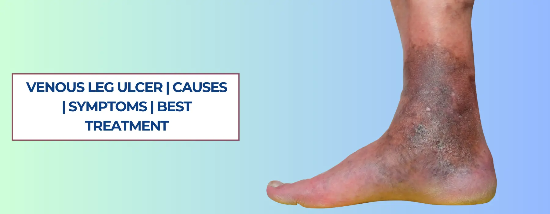 What is Venous Ulcer