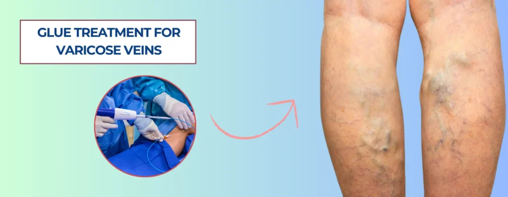 Glue Treatment for Varicose Veins