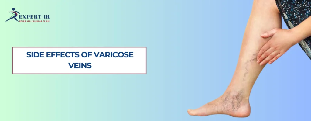 Side Effects of Varicose Veins