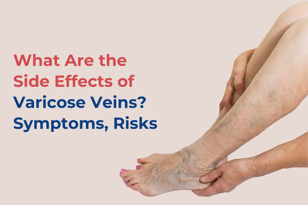 what are the Side Effects of Varicose Veins