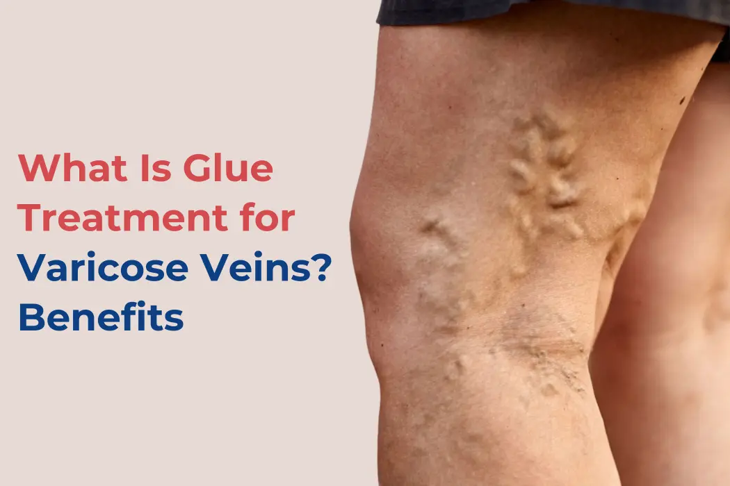 what is Glue Treatment for Varicose Veins