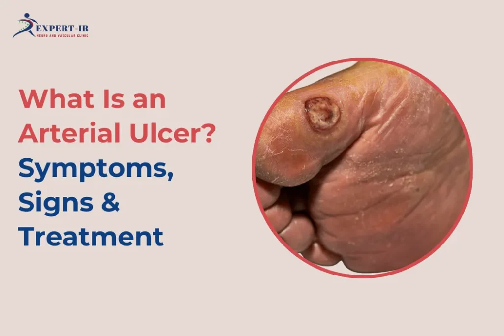 Arterial Ulcer