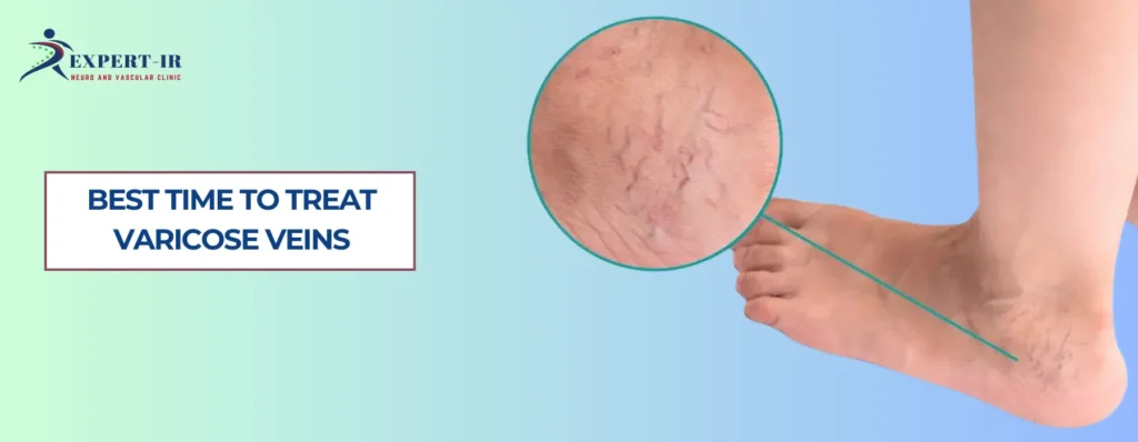 Best Time to Treat Varicose Veins