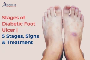 Diabetic Foot Ulcer stages