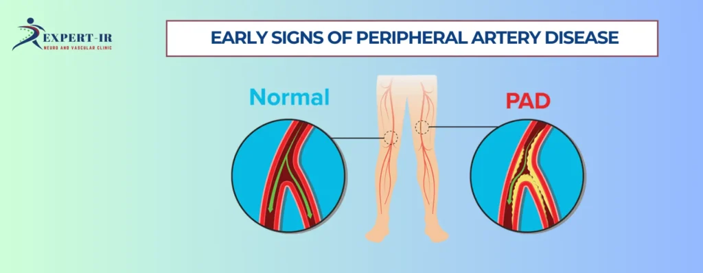 Early Signs of Peripheral Artery Disease Most People Ignore