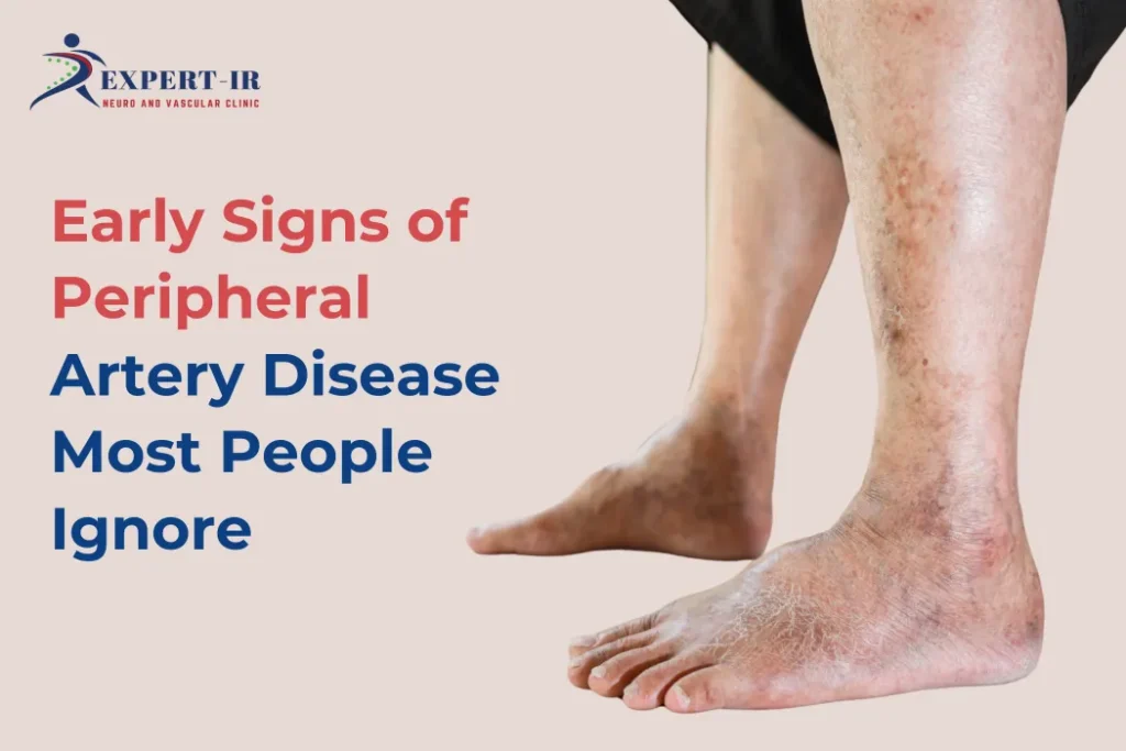 Signs of Peripheral Artery Disease