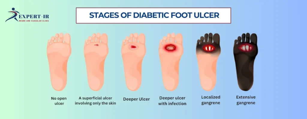 Stages of Diabetic Foot Ulcer