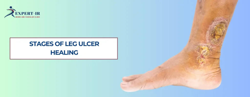 Stages of Leg Ulcer Healing