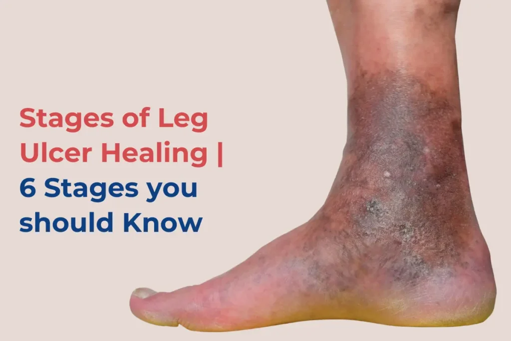 Stages of venous Leg Ulcer Healing
