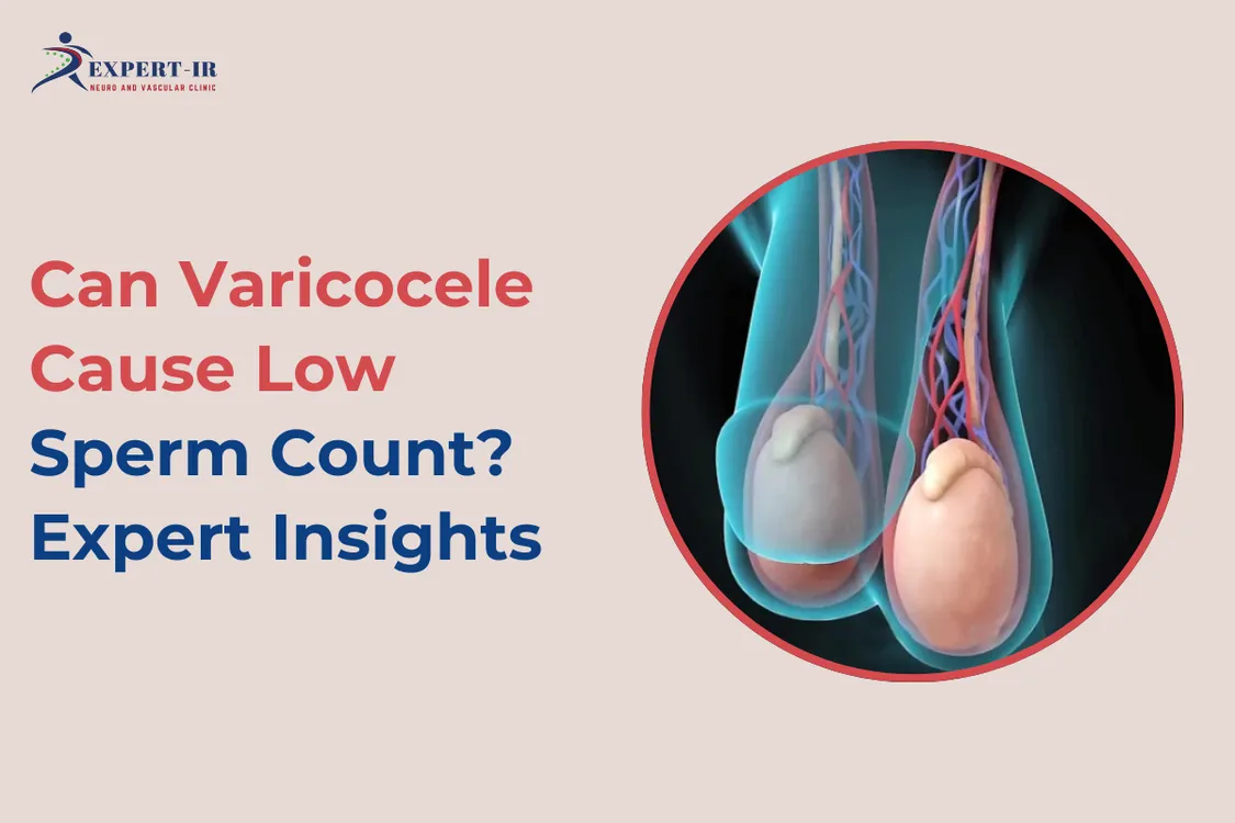 Varicocele and Low Sperm Count