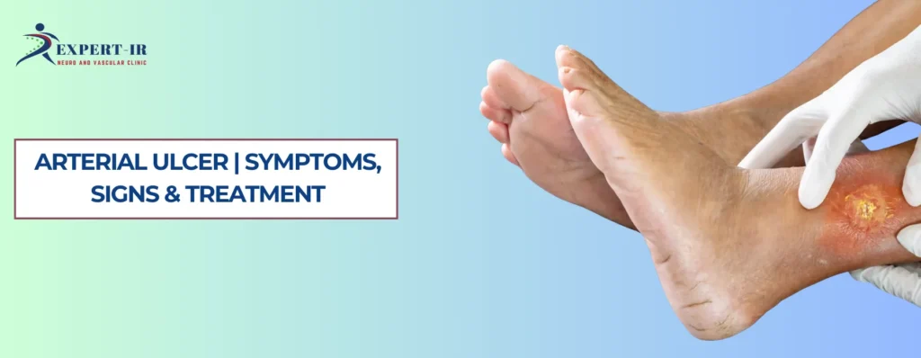 What Is an Arterial Ulcer