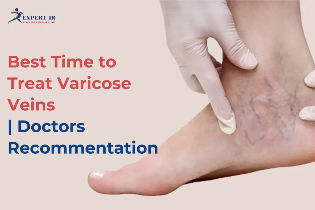 best time for Varicose Veins treatment