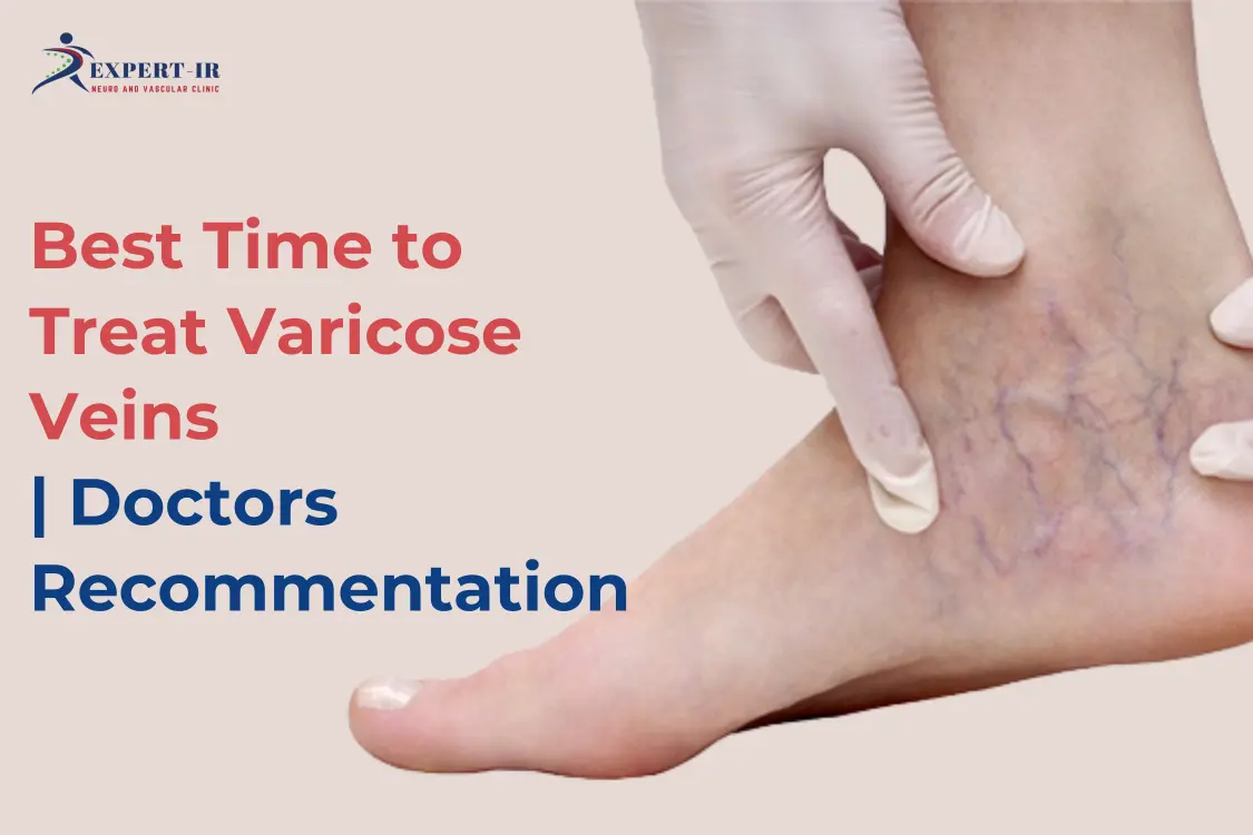 best time for Varicose Veins treatment