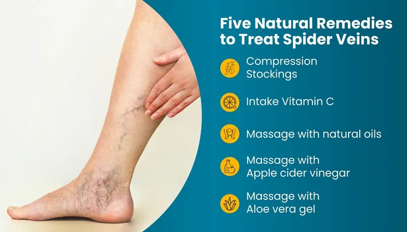 how-to-treat-spider-veins-at-home