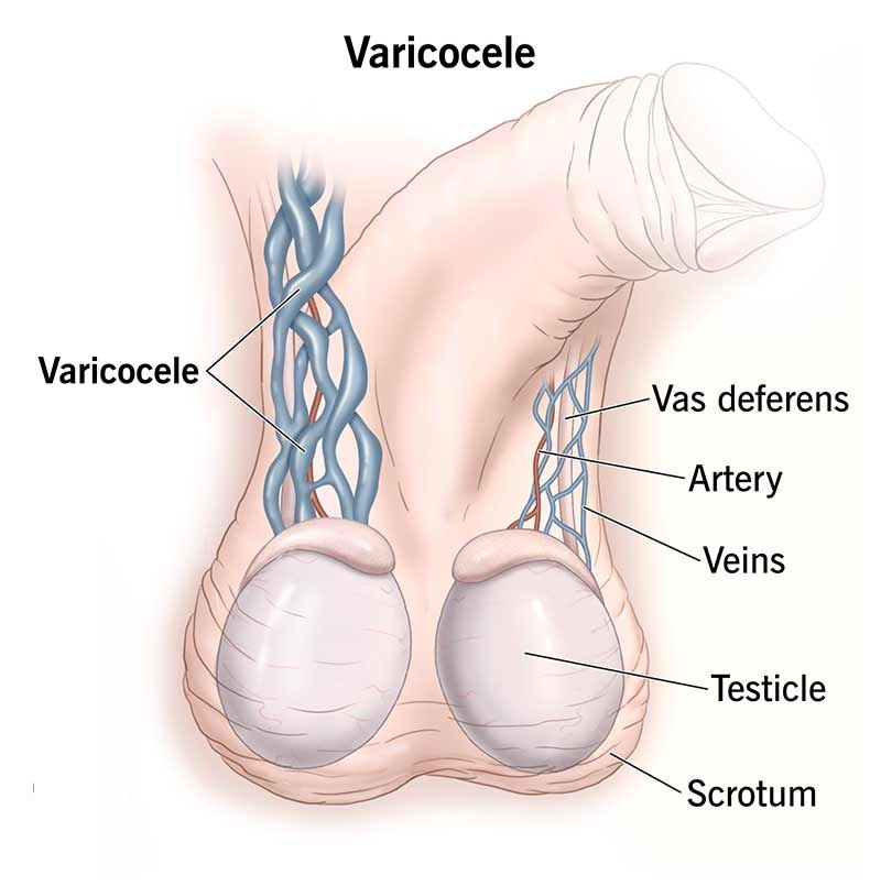 varicocele-and-low-spem-count