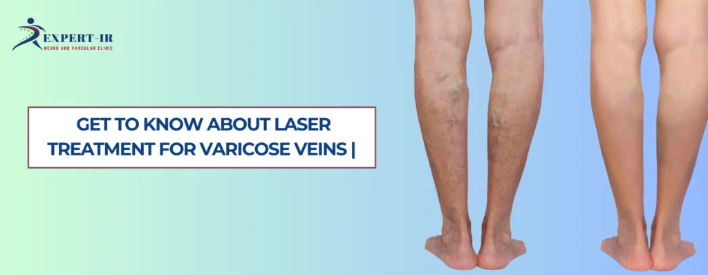 Is Laser Treatment for Varicose Veins Permanent