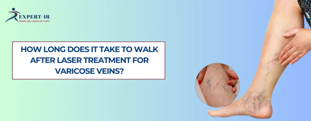 Laser Treatment for Varicose Veins
