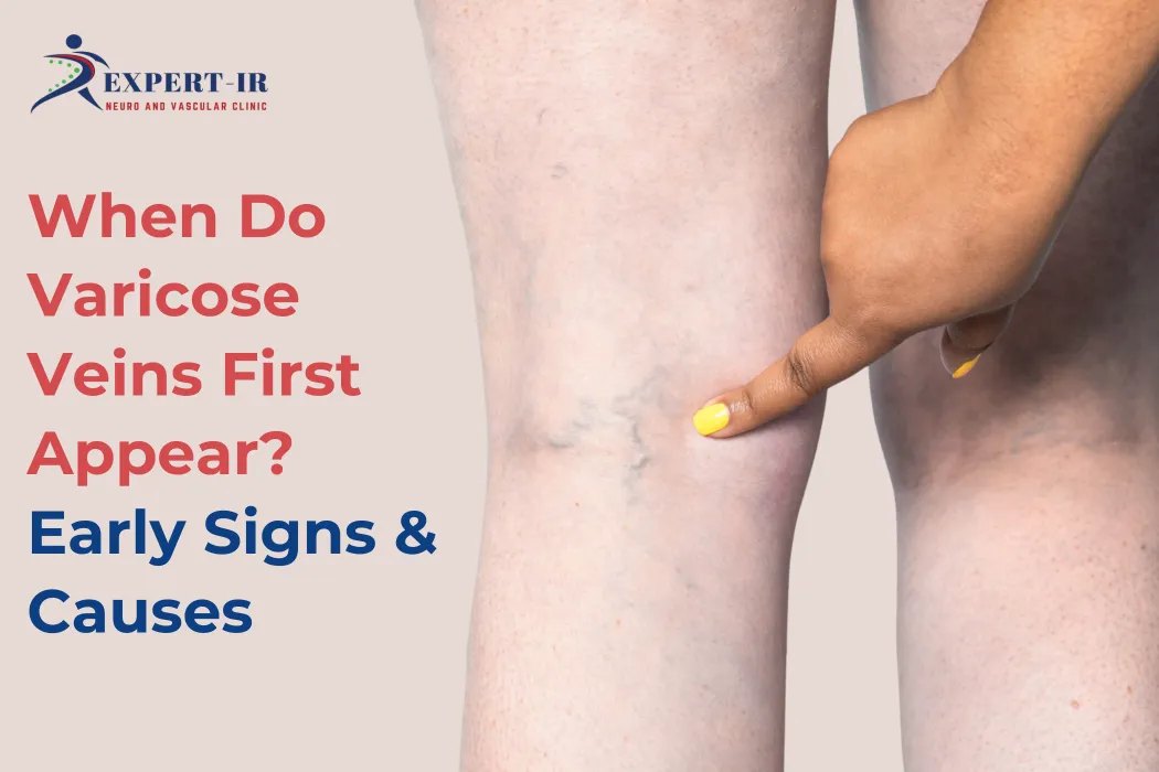 Varicose Veins Signs & Causes