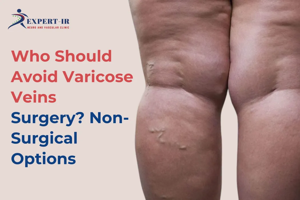 Varicose Veins Surgery risks