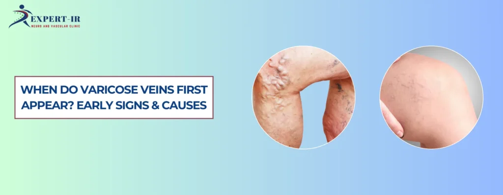 When Do Varicose Veins First Appear