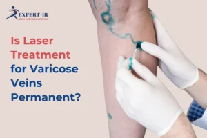 get to know Laser Treatment for Varicose Veins