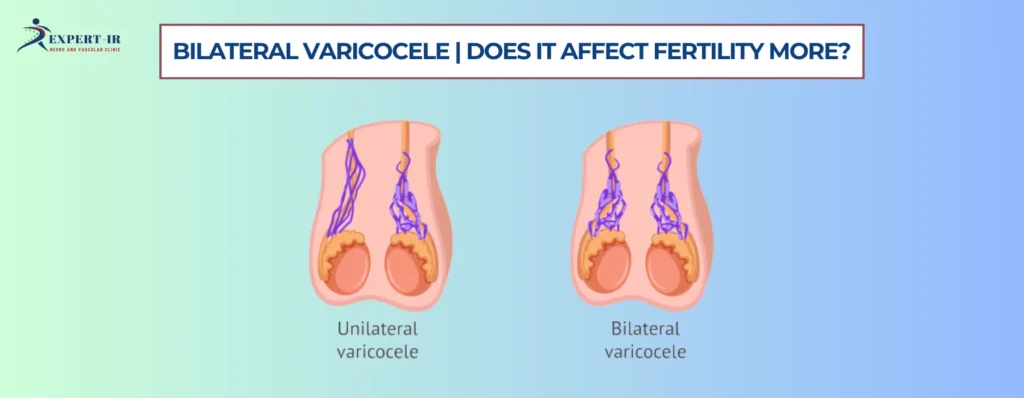 Bilateral Varicocele