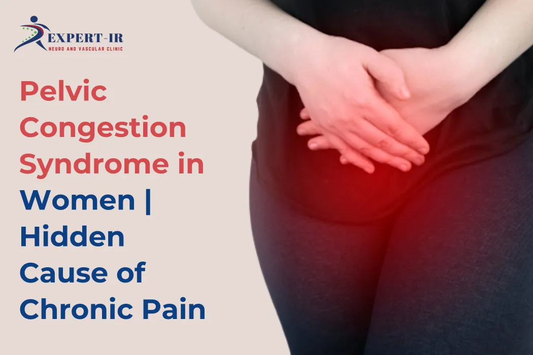 Pelvic Congestion Syndrome Treatment in Pune