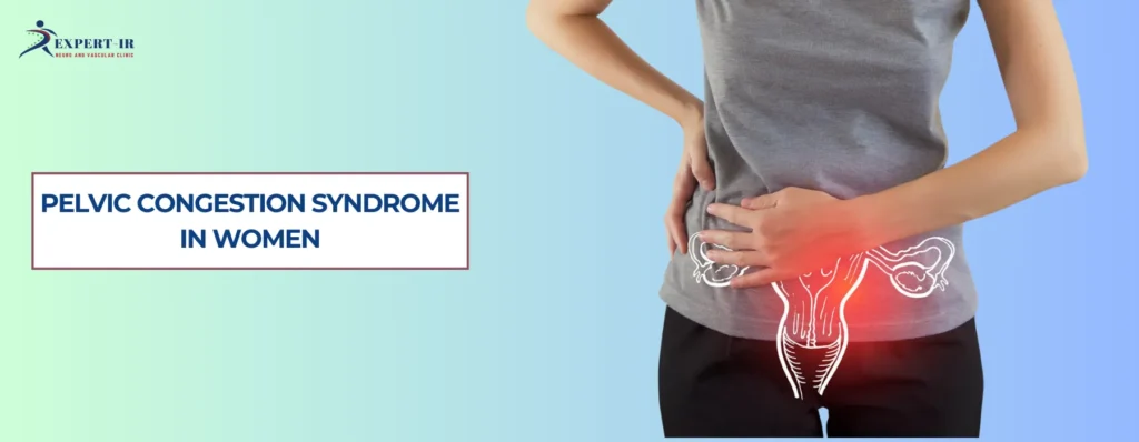 Pelvic Congestion Syndrome in Women