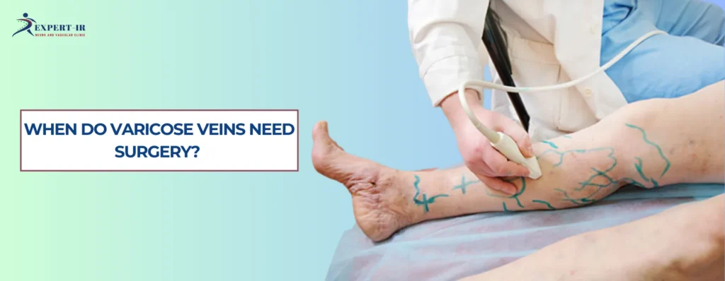 When Do Varicose Veins Need Surgery