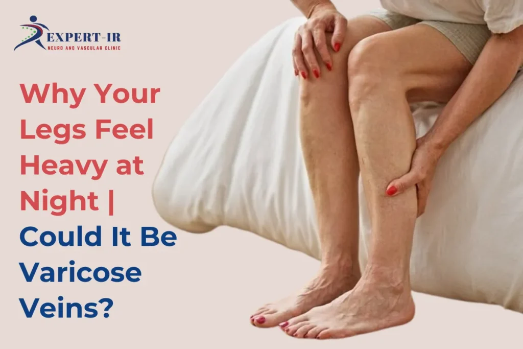 vaircose veins symptoms