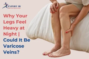 vaircose veins symptoms