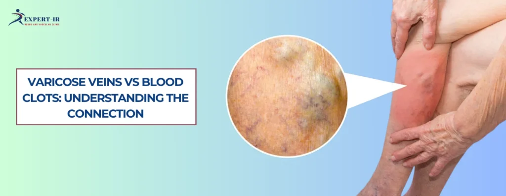 Can Varicose Veins Cause Blood Clots