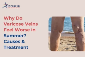 How Summer Heat Affects Varicose Veins