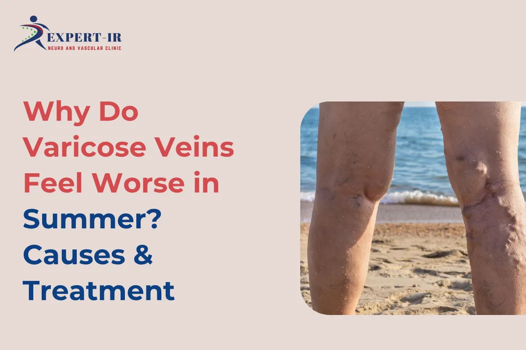 How Summer Heat Affects Varicose Veins