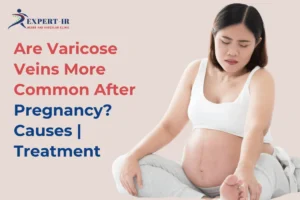 Post Partum Vaircose Veins