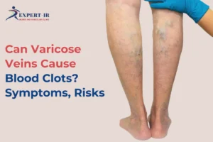 Varicose Veins vs Blood Clots