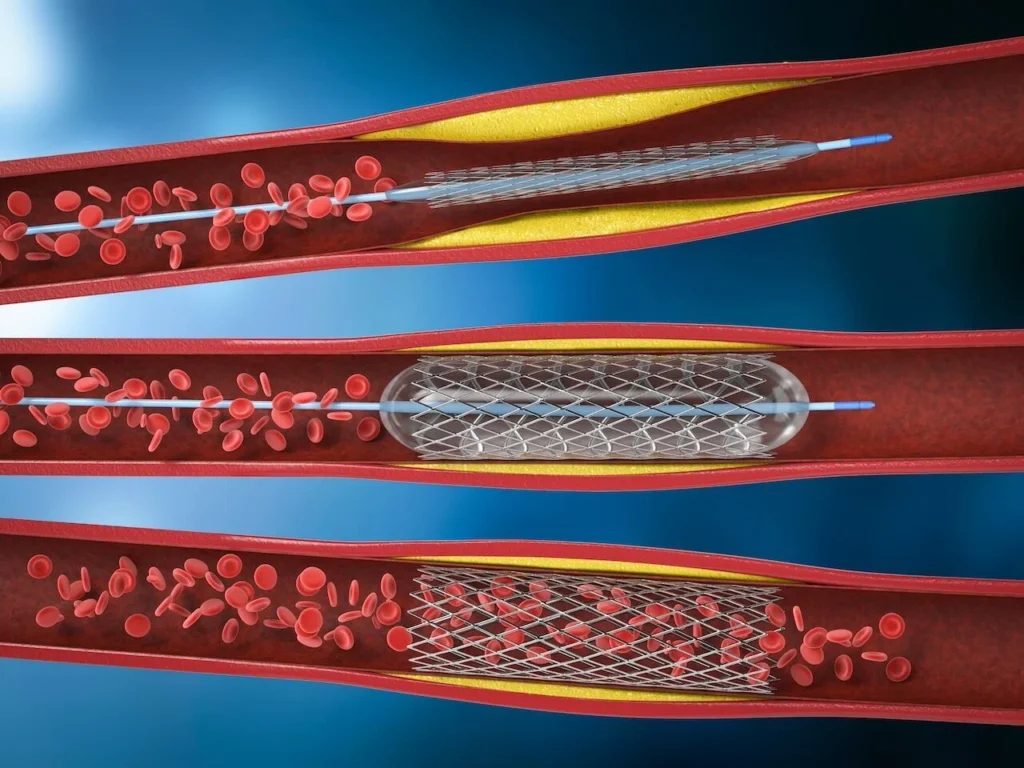 angioplasty in pad
