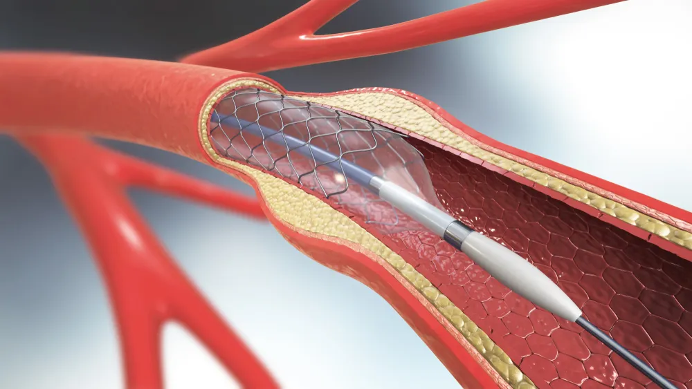 atherectomy in pad