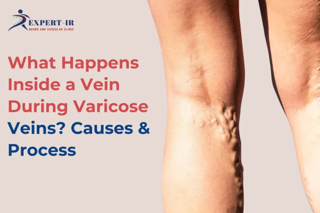 HOw to care in Varicose Veins