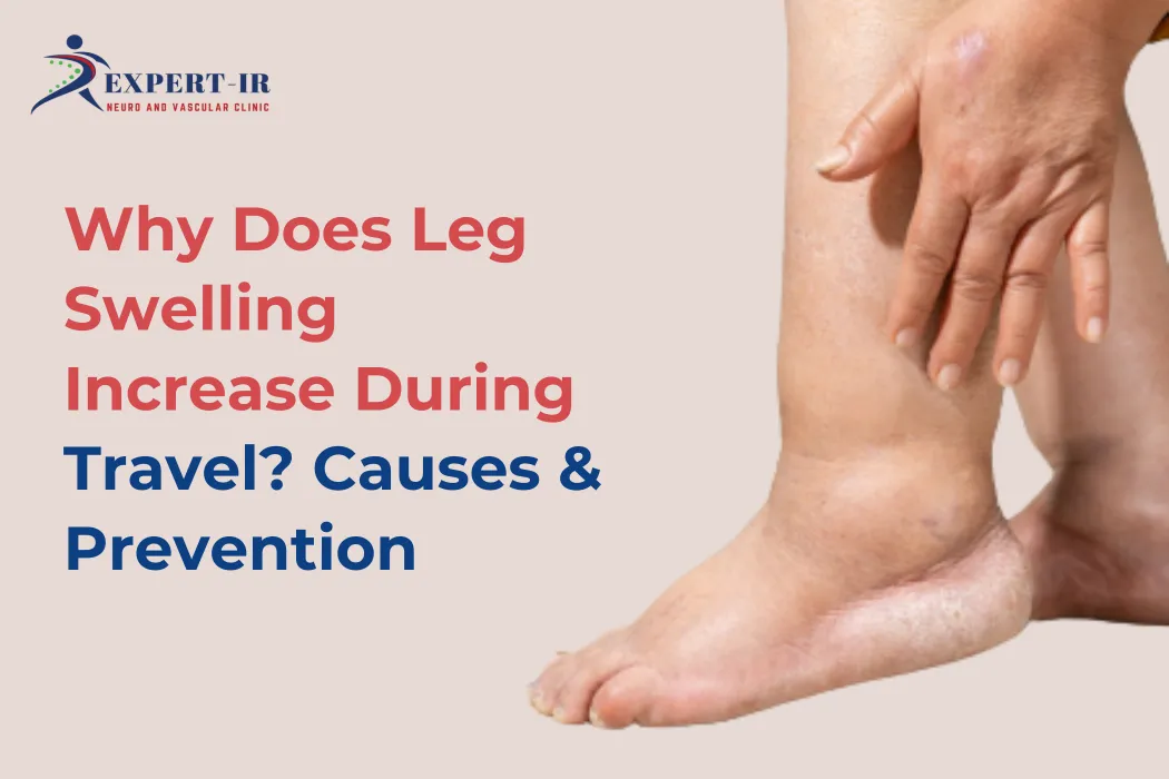 Leg Swelling After Travelling