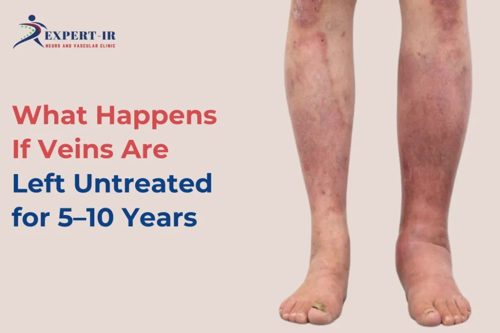 Long-Term Effects of Untreated Varicose Veins