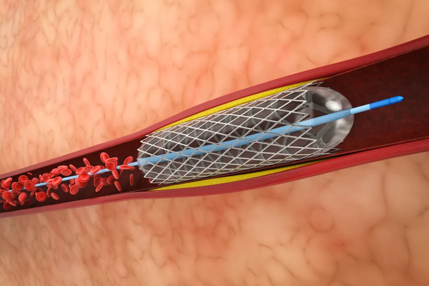 peripheral angioplasty