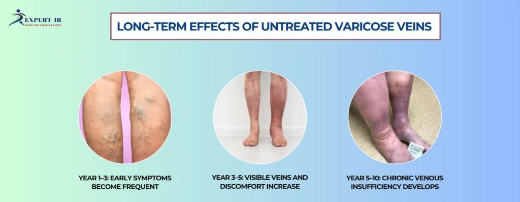What Happens If Veins Are Left Untreated for 5–10 Years