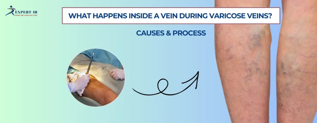 What Happens Inside a Vein During Varicose Veins